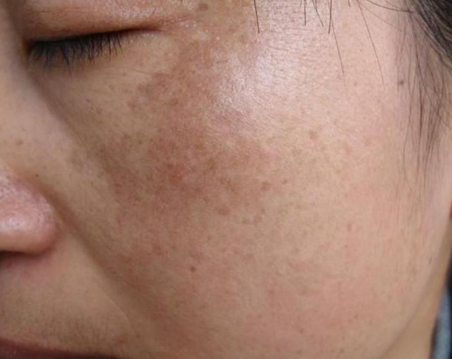 祛斑并不难，坚持这些习惯让你拥有嫩滑亮肤|色斑|长斑|美白|