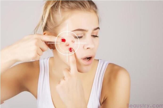 <strong>数万人都在围观这几种祛痘印方法</strong>