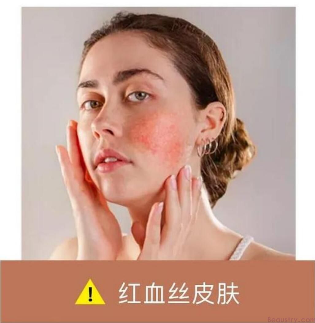 <strong>怎样选择精油？修复红血丝，恢复毛细血管弹性，修复痘印提亮肤色</strong>