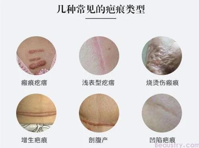 疤痕如何形成？详细解析疤痕的成因、分类和治疗方式