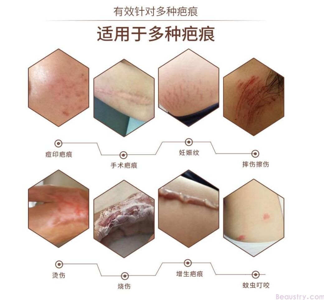 凹陷疤痕祛除方法大揭秘，让你重拾自信！